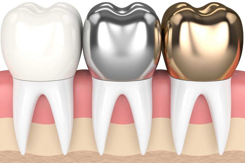 Dental Crown